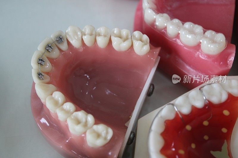 牙套和固定器的牙科模型