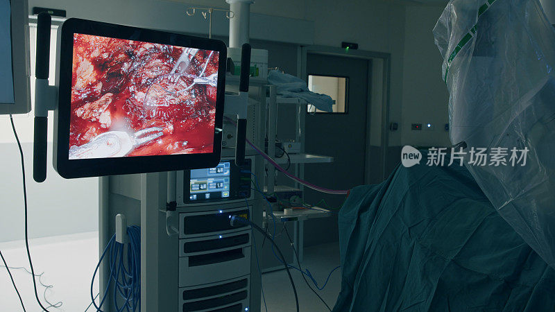 腹腔镜手术中，医疗机器人上的摄像机在监视器上播放视频
