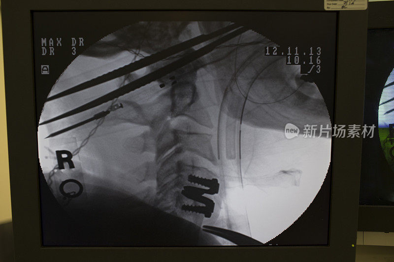 颈部手术x光