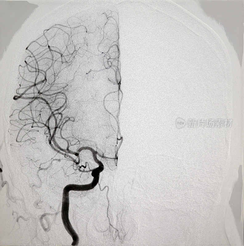 颈内动脉DSA图像