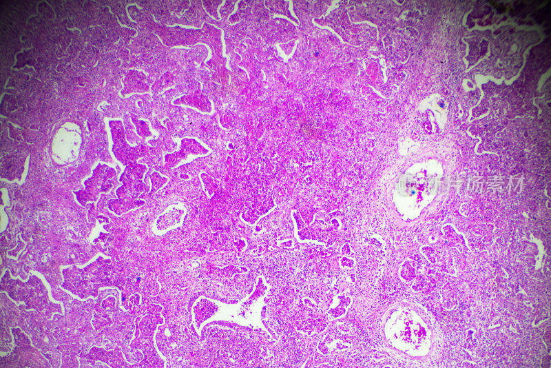 大叶性肺炎人类生物样本显微镜下