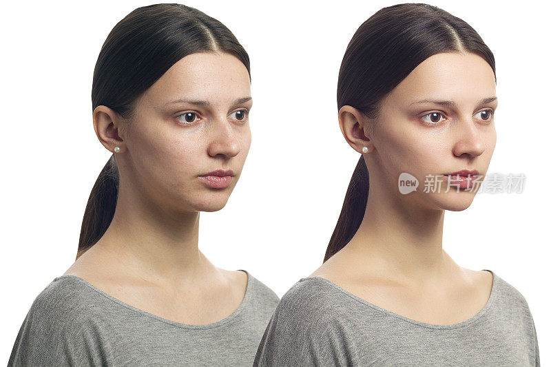 修饰-美丽的年轻女人的脸与问题皮肤在她的脸之前和之后。孤立在白色