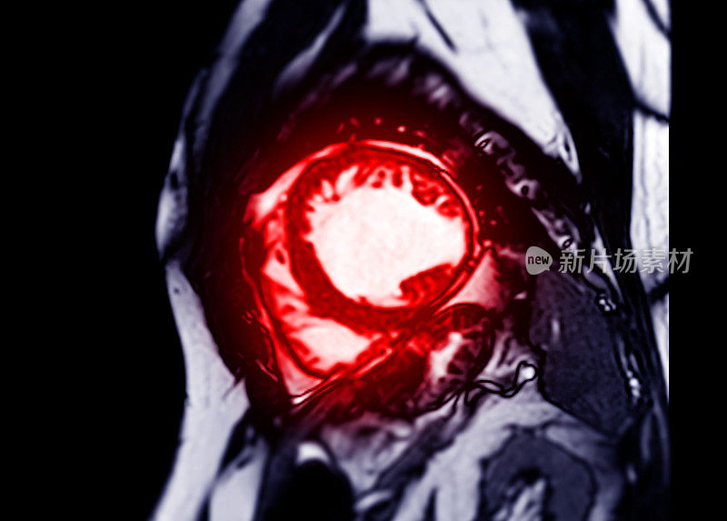 心脏MRI或心脏MRI短轴视图显示左心室和右心室的横切面，用于诊断心脏病。