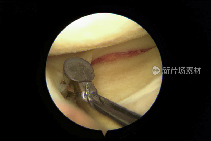 膝关节外侧腔室半月板撕裂的关节镜观察