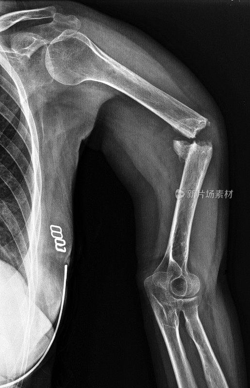 肱骨骨折的x射线。