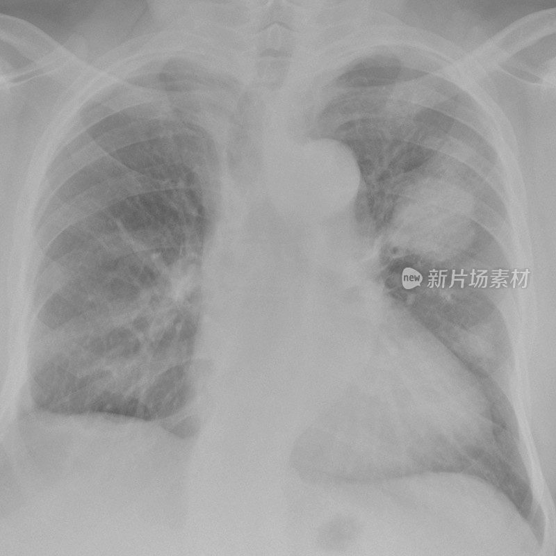 一名左肺癌吸烟者的数字胸部x光片
