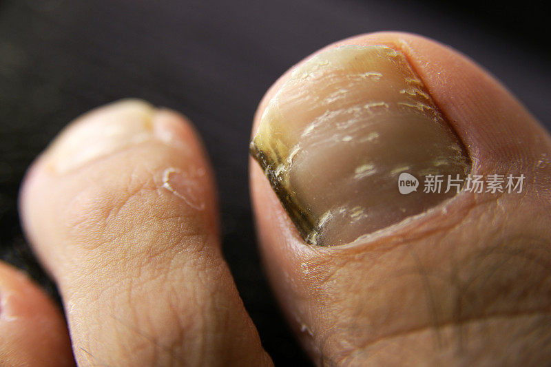 脚趾甲真菌
