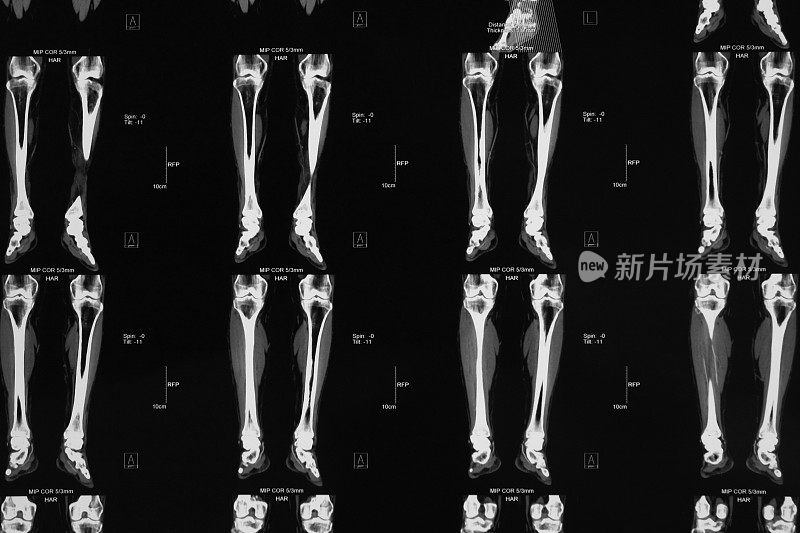 CT下肢血管造影…外周动脉闭塞症