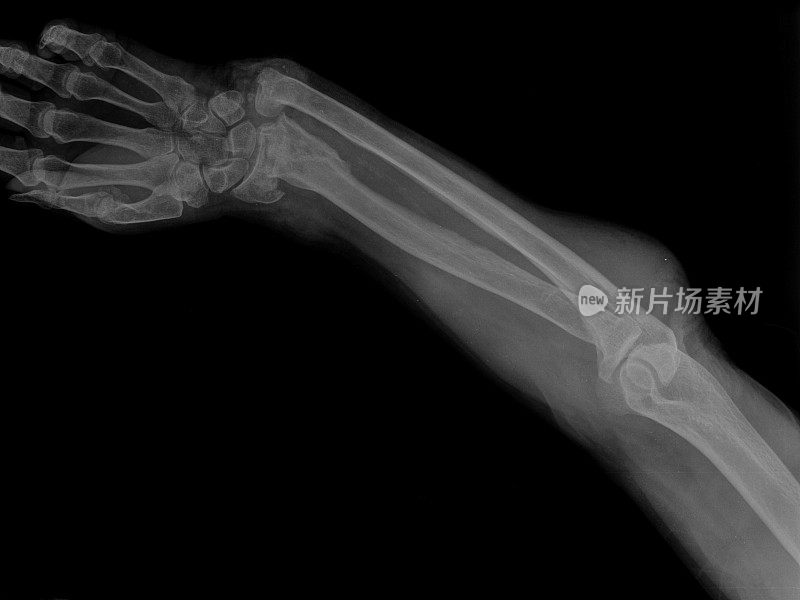 骨折手臂的x线照片