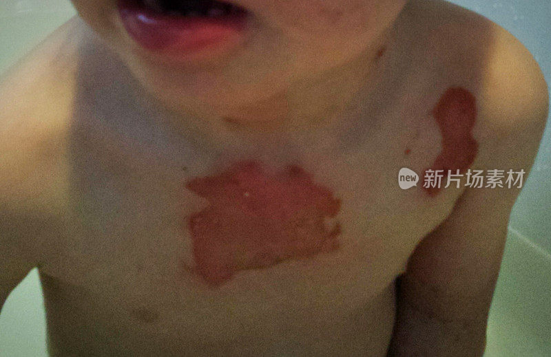 一个幼童胸部二级烧伤