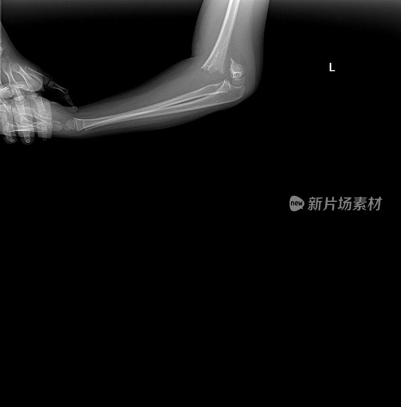 手臂骨折x射线