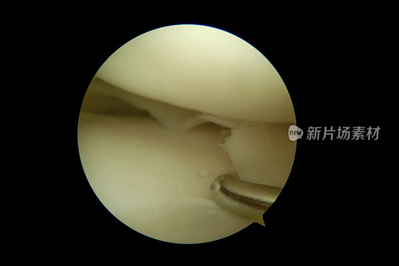 右膝内侧隔室半月板撕裂的关节镜观察