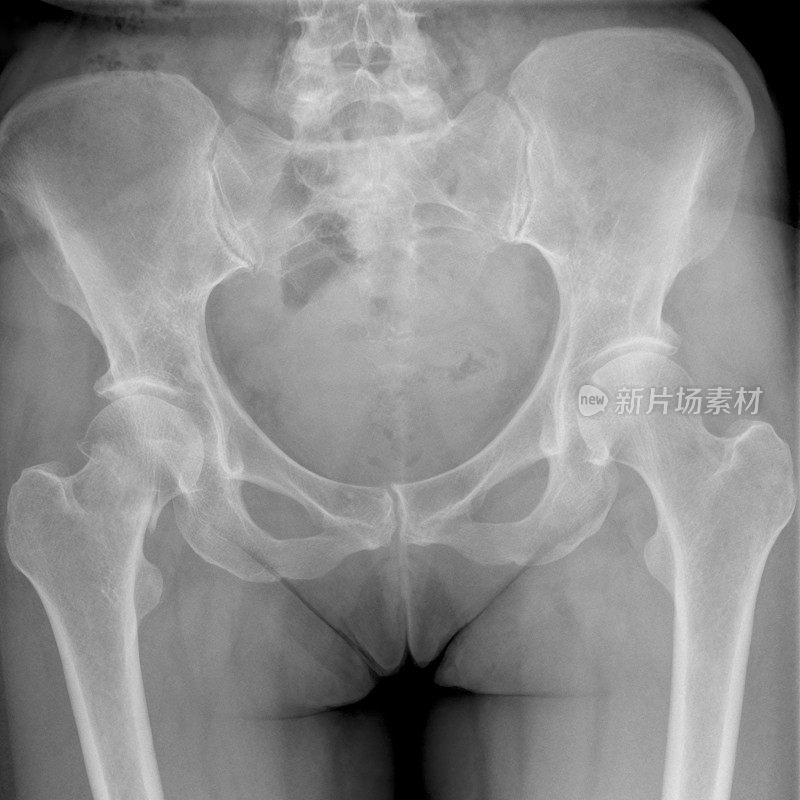 骨质疏松伴右股骨颈骨折的骨盆x线照片