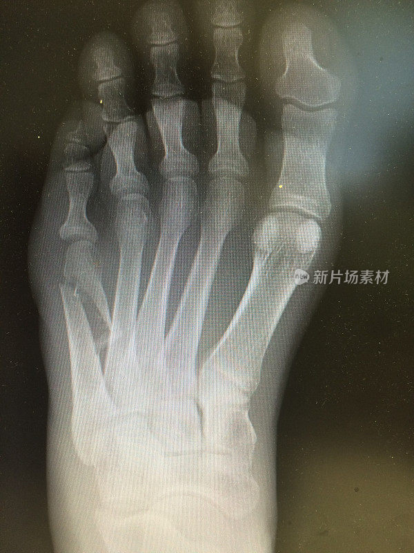 足部骨折x线照片，AP视图