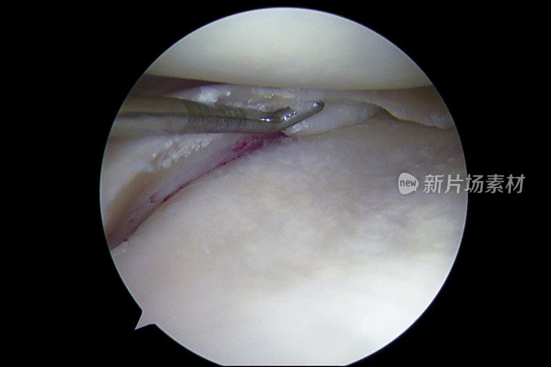 膝关节骨性关节炎和退行性半月板撕裂的关节镜观察