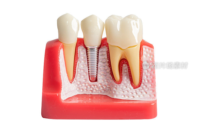 种植牙，下颌人工牙根，牙根管治疗，牙病白底夹径，牙科研究用牙模型。