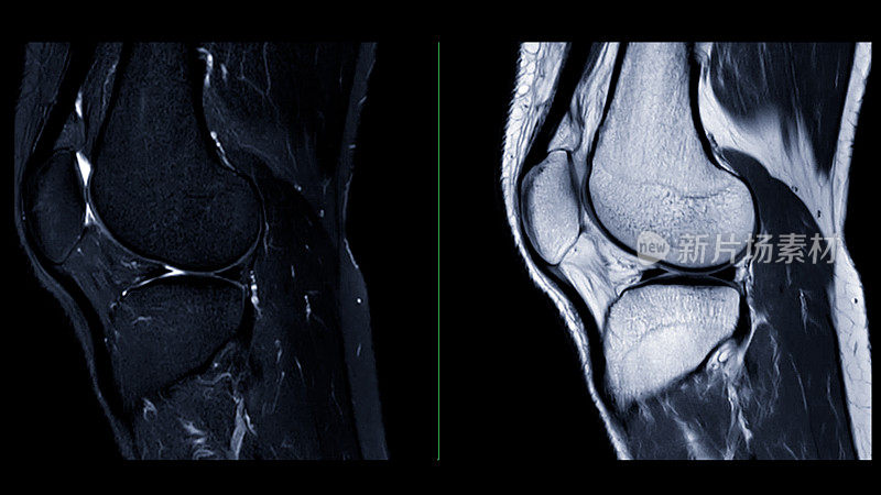 膝关节的磁共振成像或MRI。这种诊断技术对于评估韧带、软骨和识别撕裂或炎症等问题至关重要。