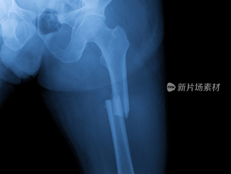 腿部骨折x光片