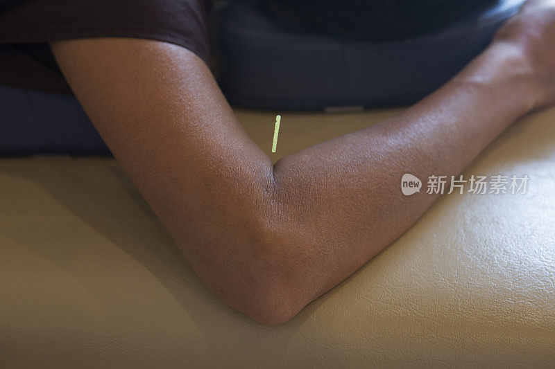 日本女性在日本京都接受针灸治疗
