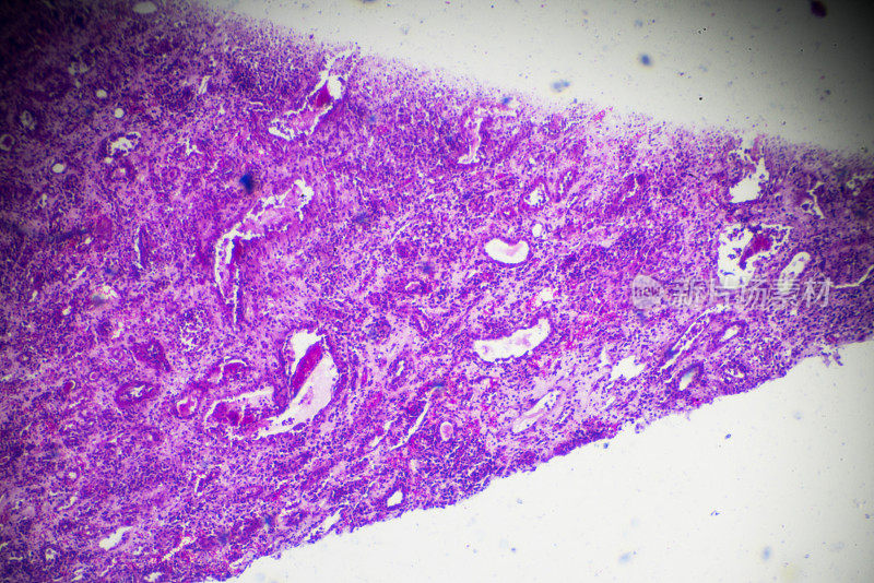 显微镜下硬化性肾小球肾炎活检标本