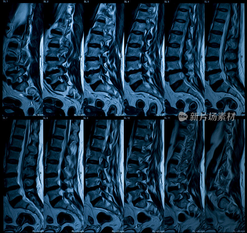 腰骶的核磁共振