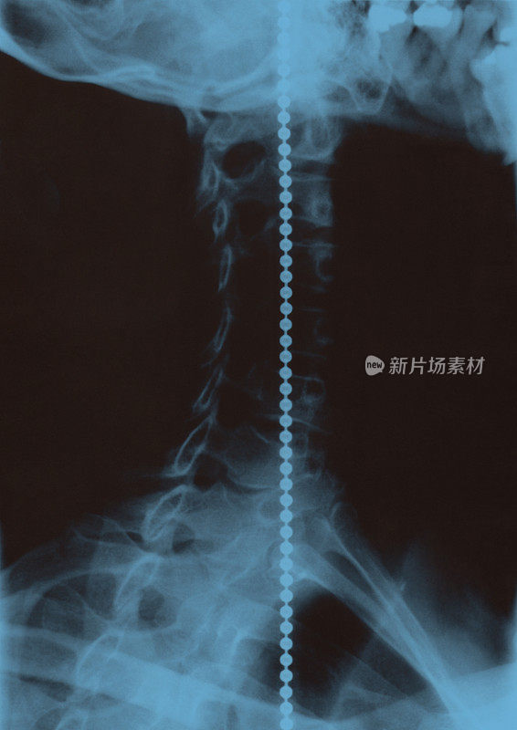 颈椎及锁骨x线照片，高分辨率扫描