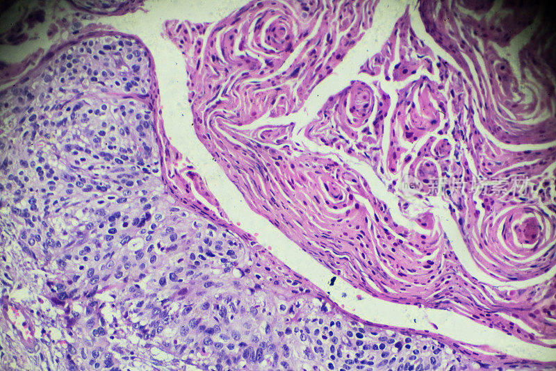 光镜下的子宫颈癌(鳞状细胞癌)