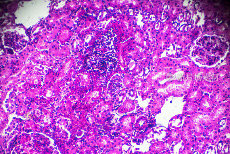 显微镜下急性肾盂肾炎活检标本