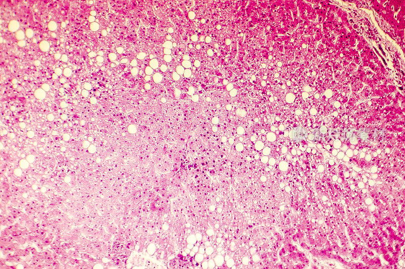 脂肪肝的光学显微镜照片