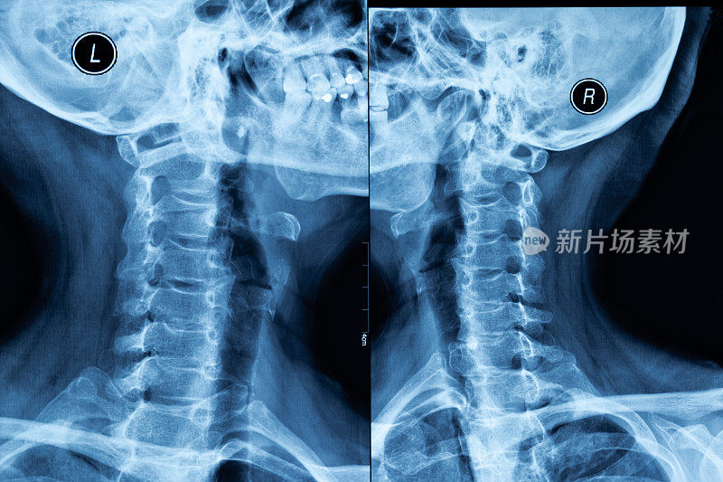 人头颈x光片