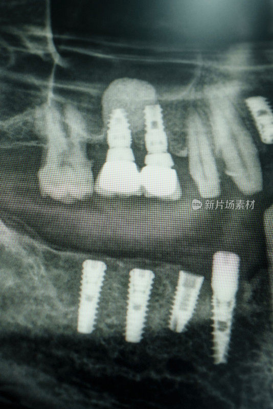 全景x线摄影(正位断层摄影)，显示牙齿结构的x光片