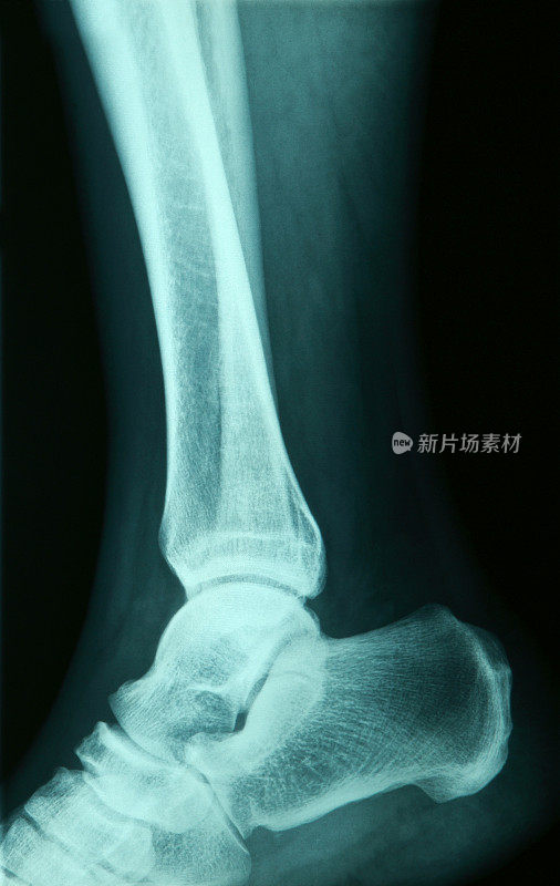 足部的x光图像。