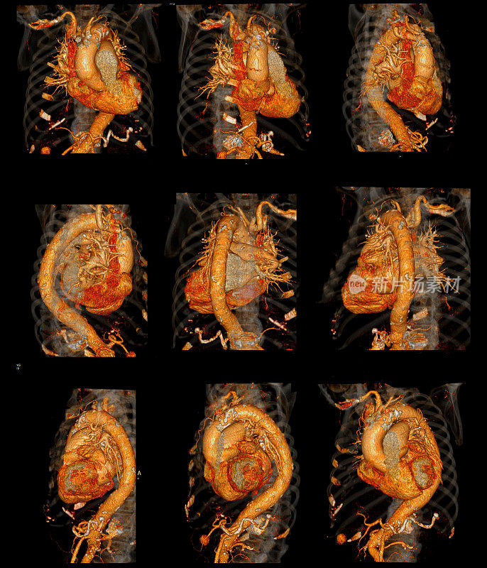 CT心脏三维渲染。