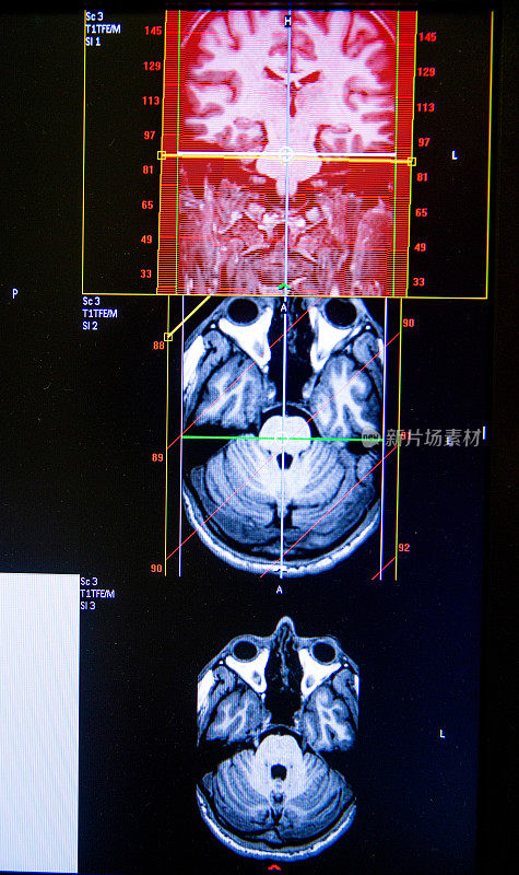 磁共振头部扫描的复合图像