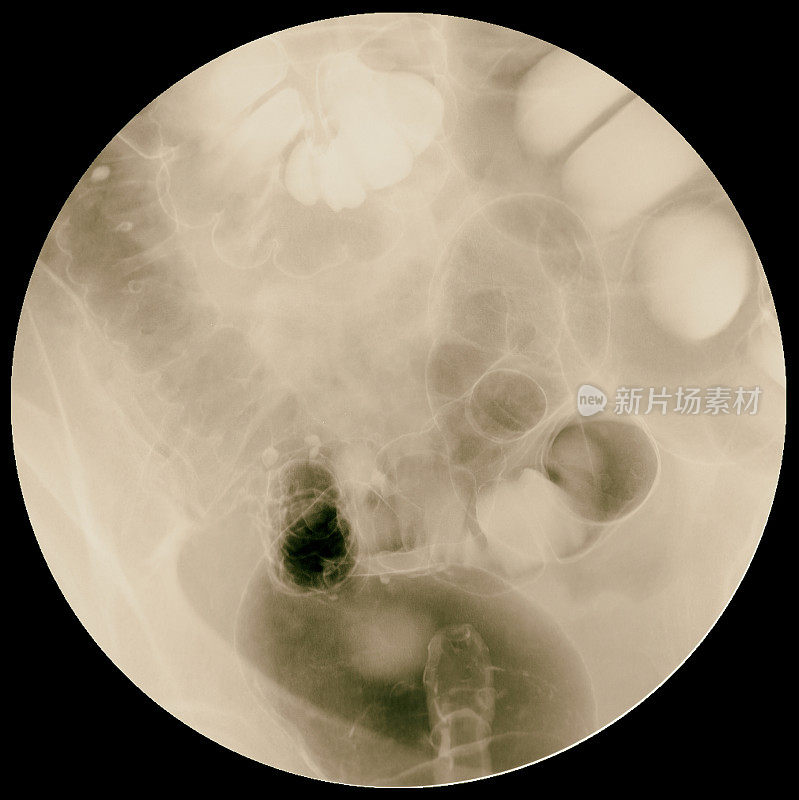 钡灌肠，双重对比研究，结直肠x线片。医院的概念