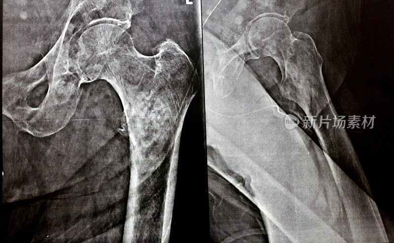 1例老年前列腺癌患者的x线平片表现为大概率股骨粗隆下、粗隆裂骨折及头部以下股骨干内侧恶性转移