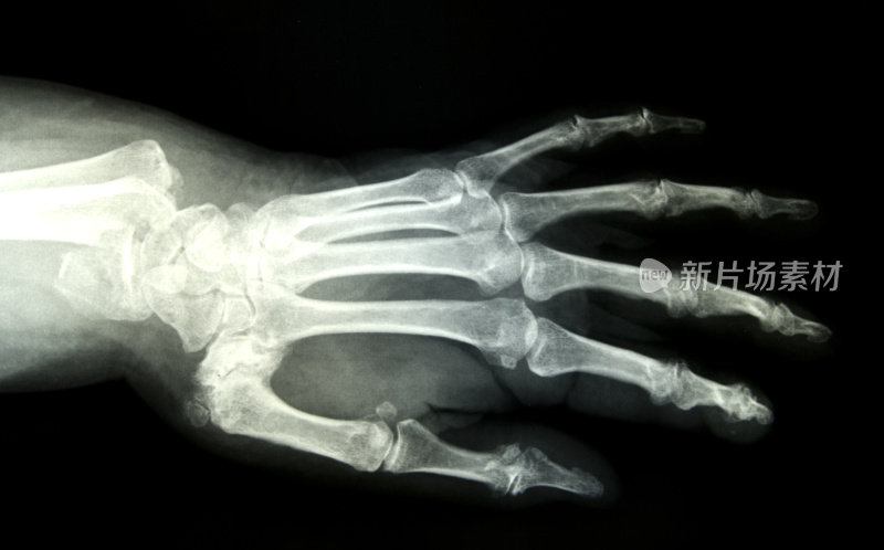 手腕骨折，手部x光片