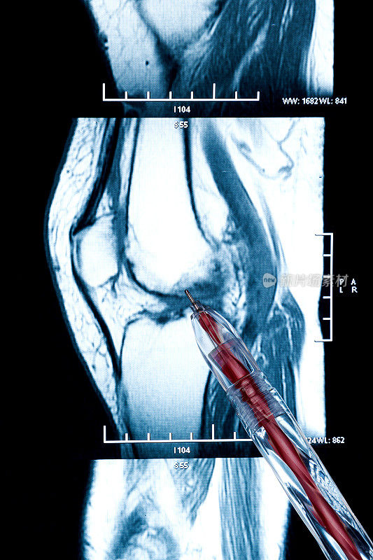 膝关节磁共振笔-交叉和半月板损伤