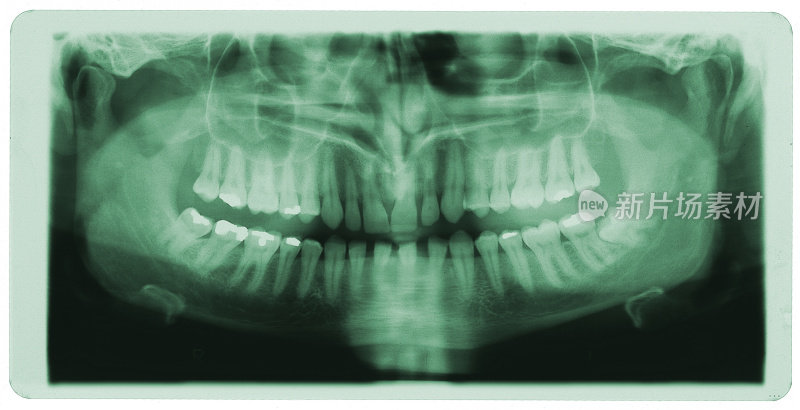 人类牙齿x光照片