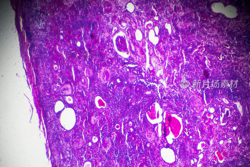 显微镜下硬化性肾小球肾炎活检标本