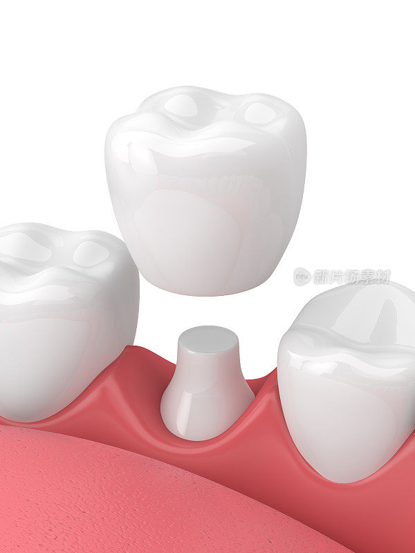 3d渲染颌骨与牙齿和牙冠修复