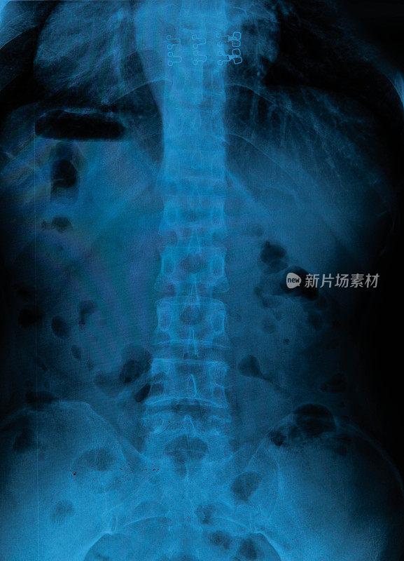 脊柱x射线胶片