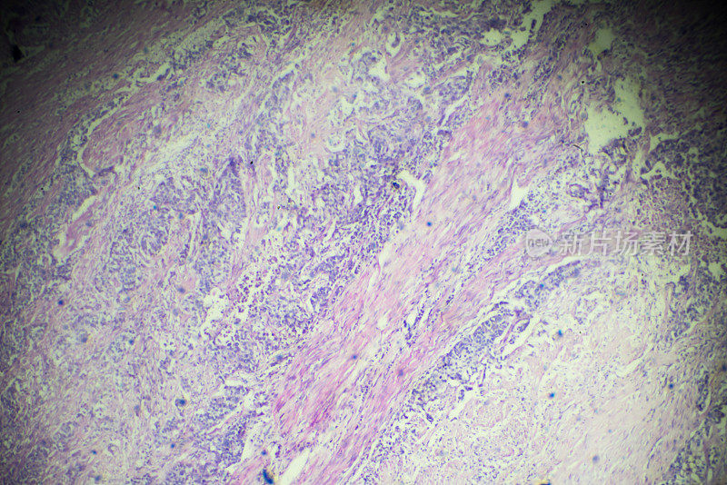膀胱移行细胞癌的显微镜观察