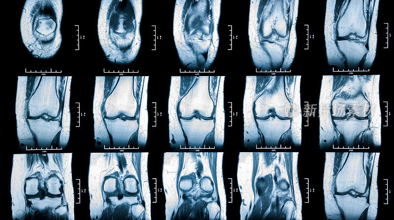 膝关节mri显示半月板骨折