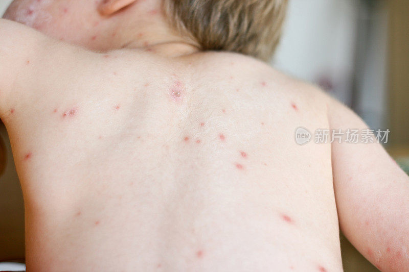 水痘在一个小男孩的背上
