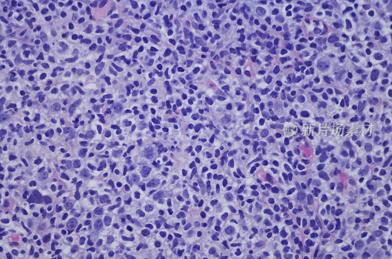 边缘区淋巴瘤，恶性b细胞