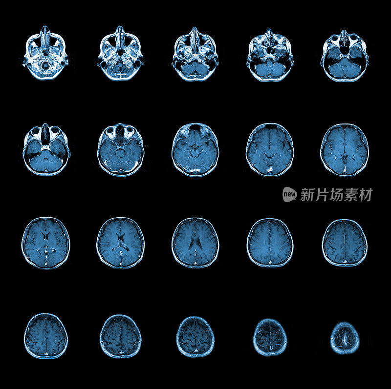 核磁共振扫描人脑