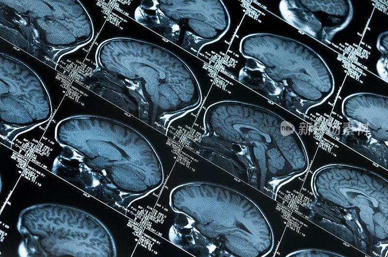 许多MRI大脑扫描的图像