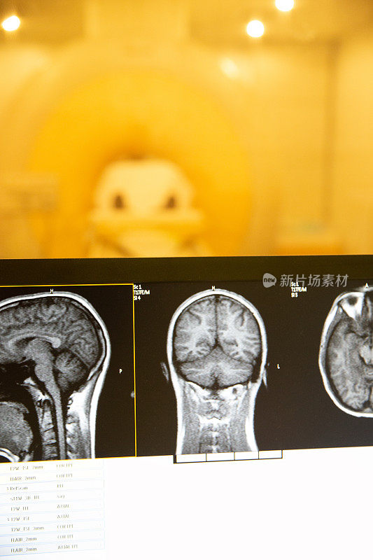 磁共振头部扫描图像在电脑显示器扫描
