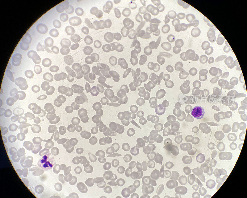 镰状细胞、正常红细胞和白细胞的血液涂片